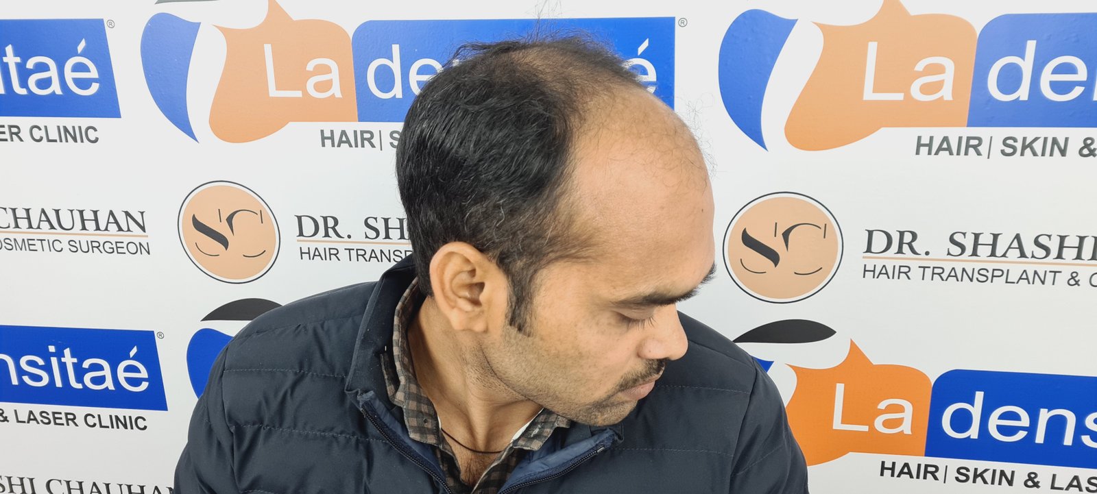 Anesh Kumar Before Hair Transplant